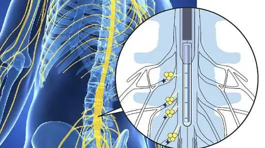 Иновативно устройство спира сигналите на болката (видео)